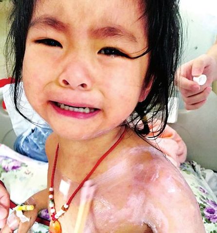 3歲的蘭蘭，全身紅疹，因疼癢難忍而大哭